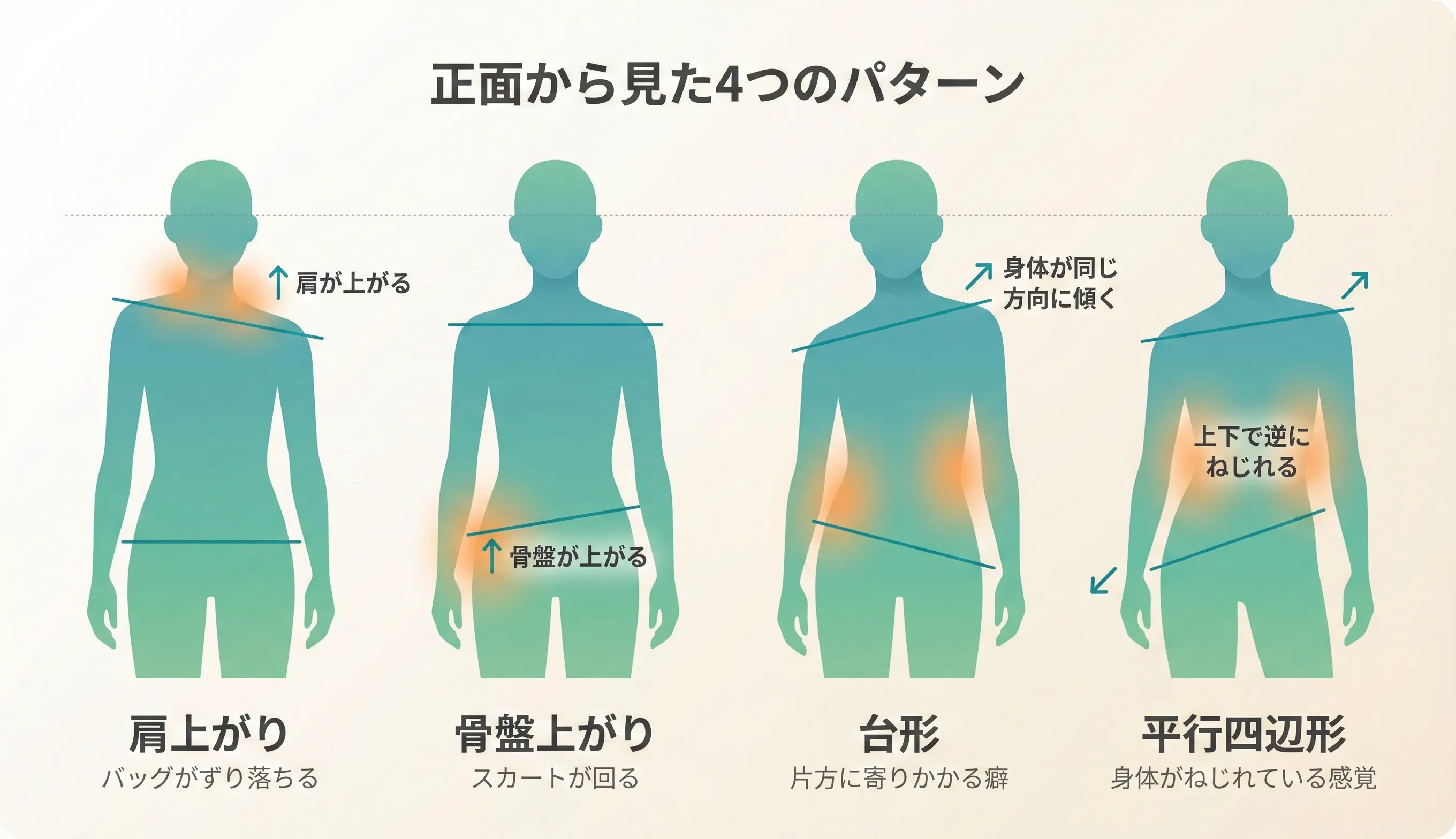 正面から見た4つの歪みパターン：片側肩上がり、片側骨盤上がり、台形（ねじれ）、平行四辺形（側屈）の図解