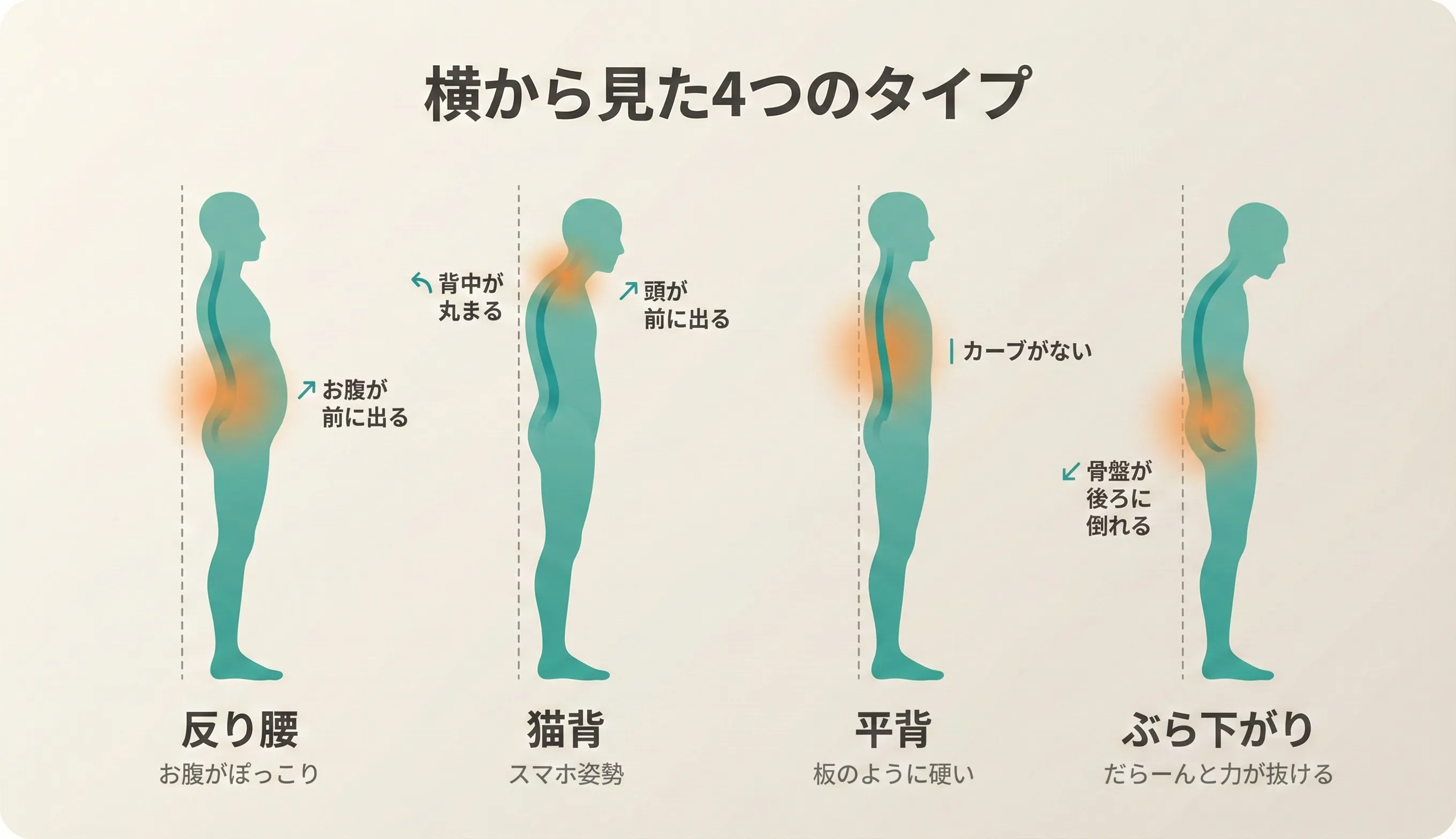 横から見た姿勢の4タイプ：反り腰タイプ（骨盤前傾）、猫背タイプ（頭部前方・背中丸まり）、平背タイプ（腰の反り少ない）、ぶら下がりタイプ（骨盤前方ずれ）の比較図