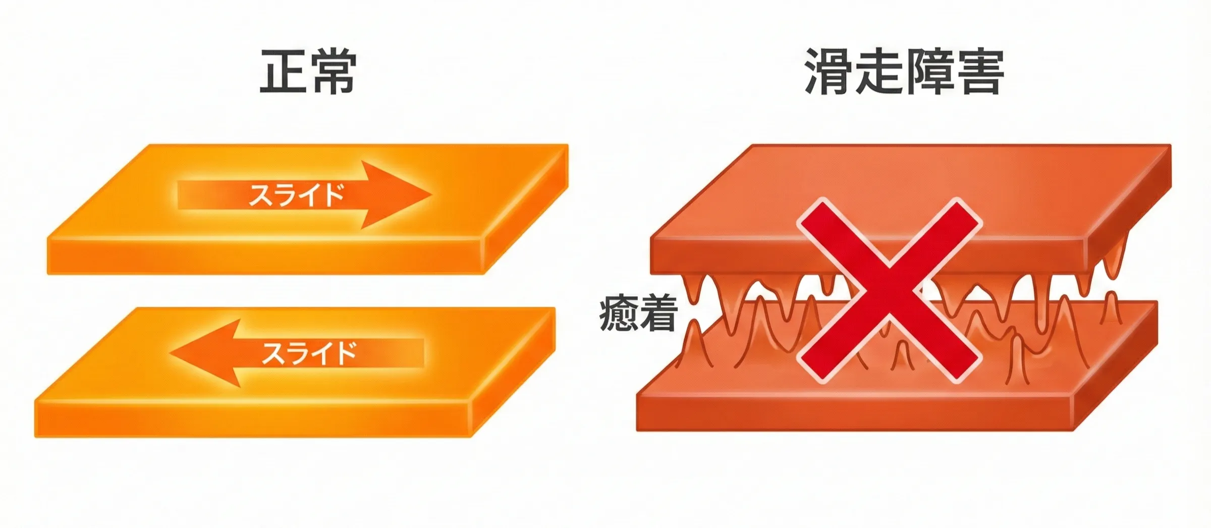 組織間滑走性のイメージ図：筋膜や組織が層のように重なり、各層がスムーズに滑走している状態と癒着している状態の比較