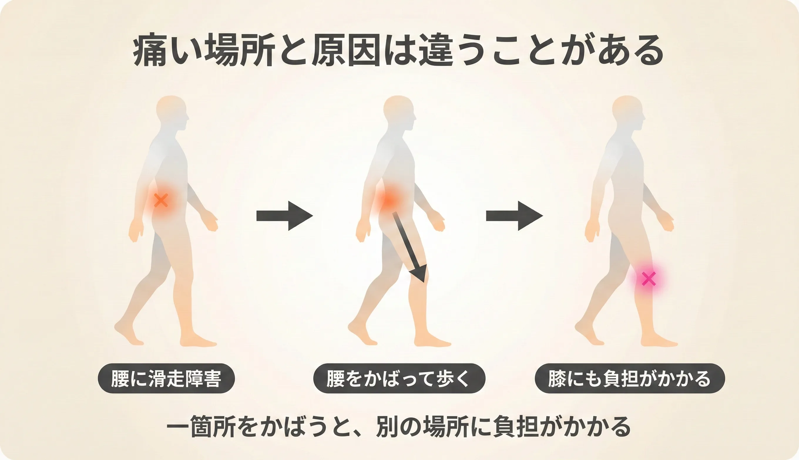 運動連鎖の概念図：一箇所の滑走障害が結合組織のネットワークを通じて別の部位に波及し、代償動作が生じるプロセスの図解