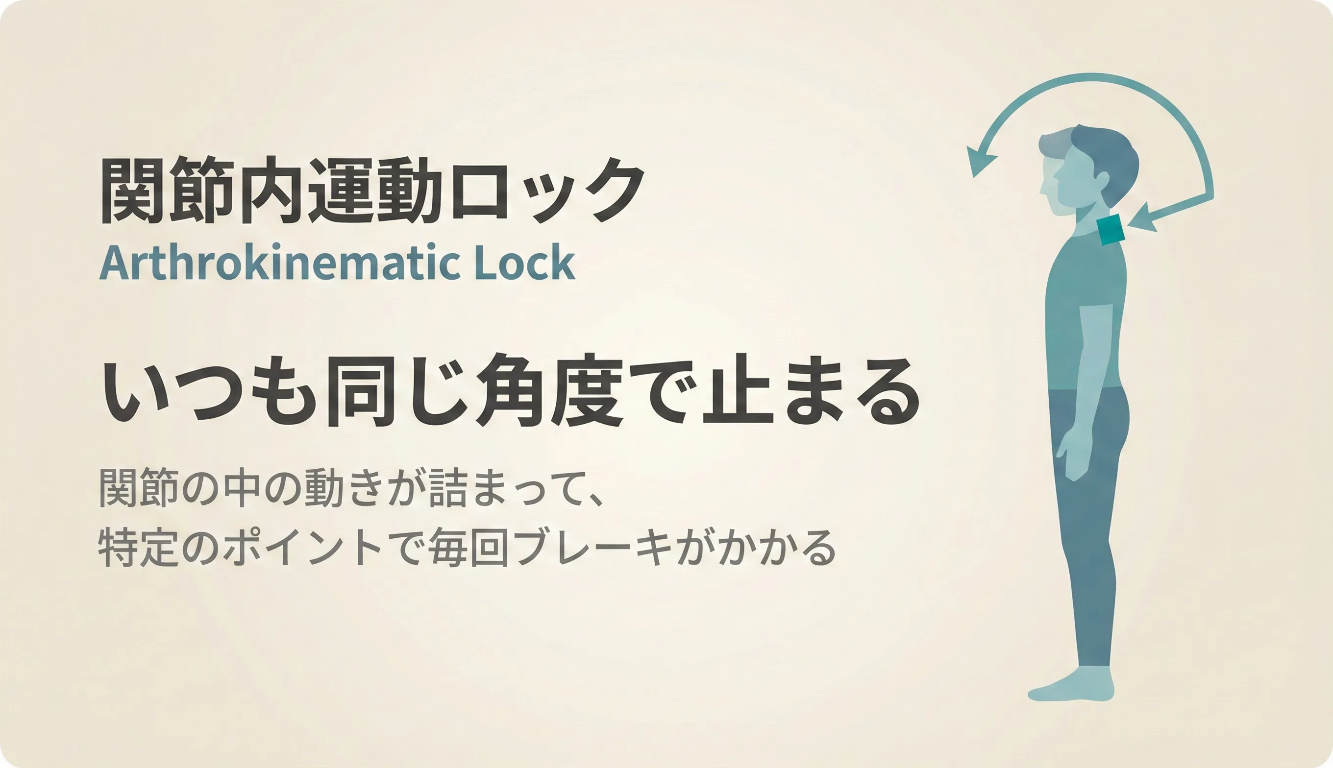 Arthrokinematic Lock（関節内運動ロック）のイメージ：関節の滑りが出ず詰まっている状態の図解
