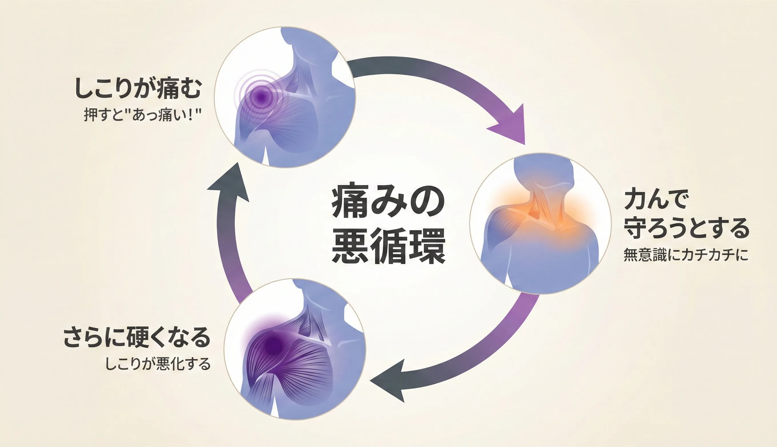 Pain Lock（痛みロック）のイメージ：押すと痛みが再現され関連痛が飛ぶ、防御反応で力んでしまう状態の図解